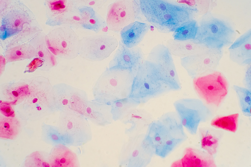 HPV Overtakes Smoking as Leading Cause of Throat Cancer